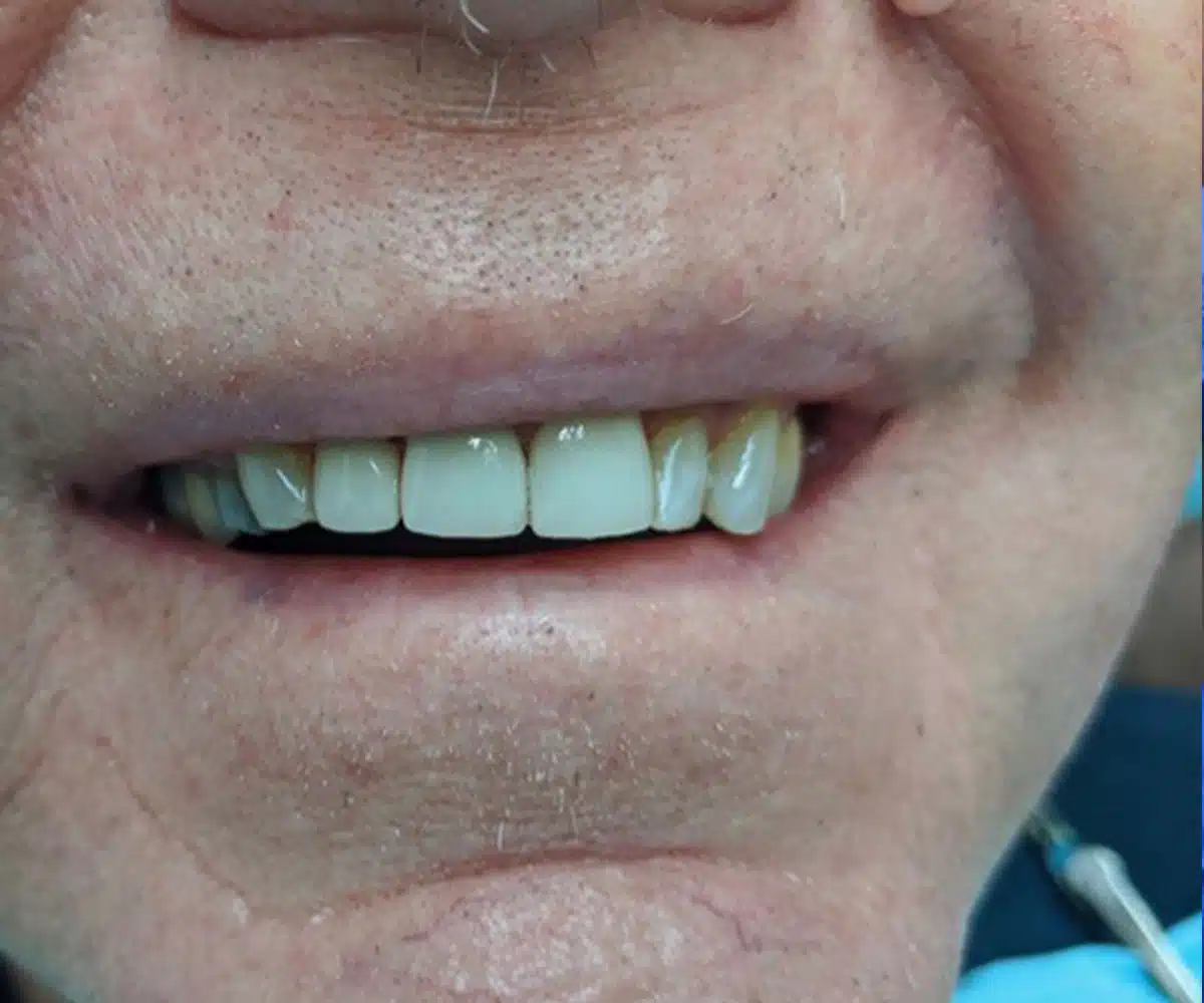 Crowns after