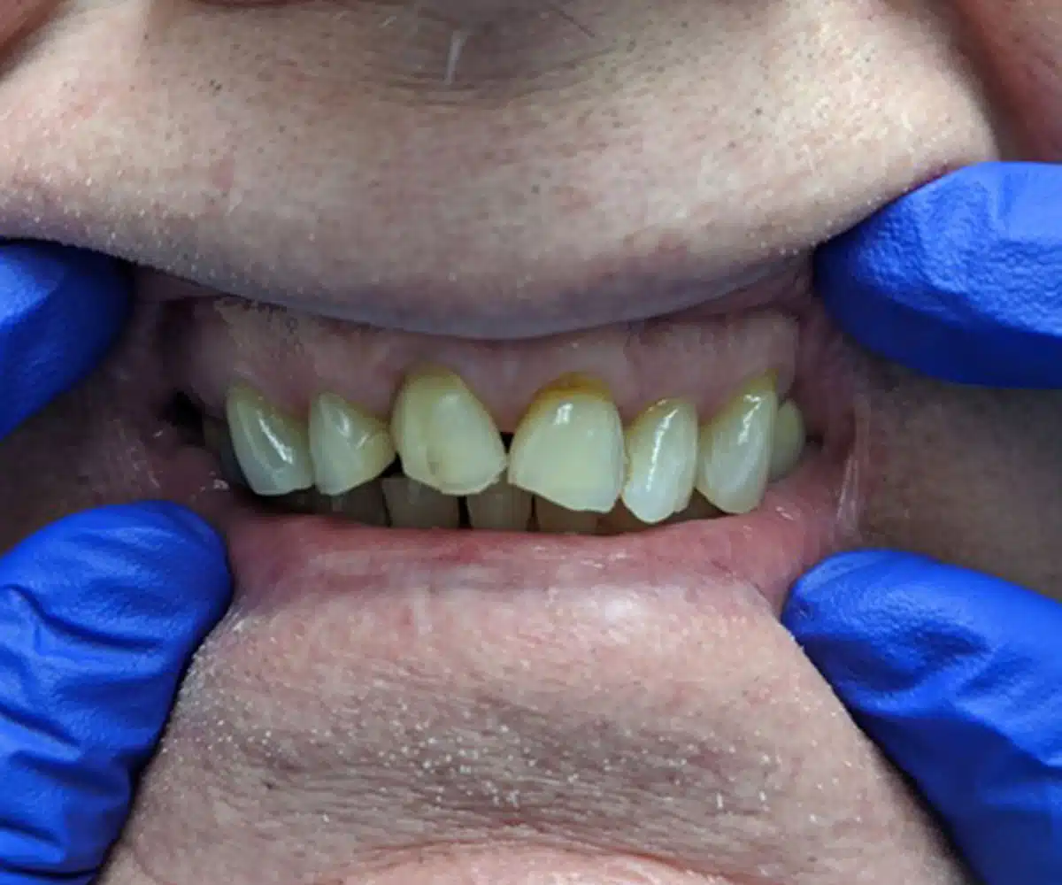 Crowns before