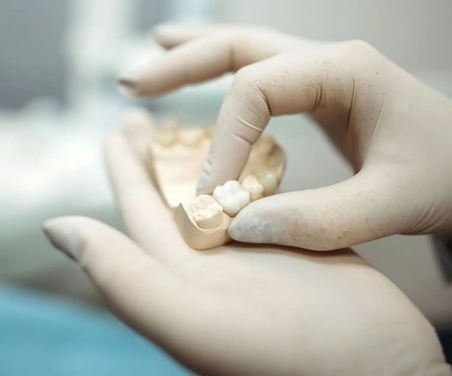 Dental Implants