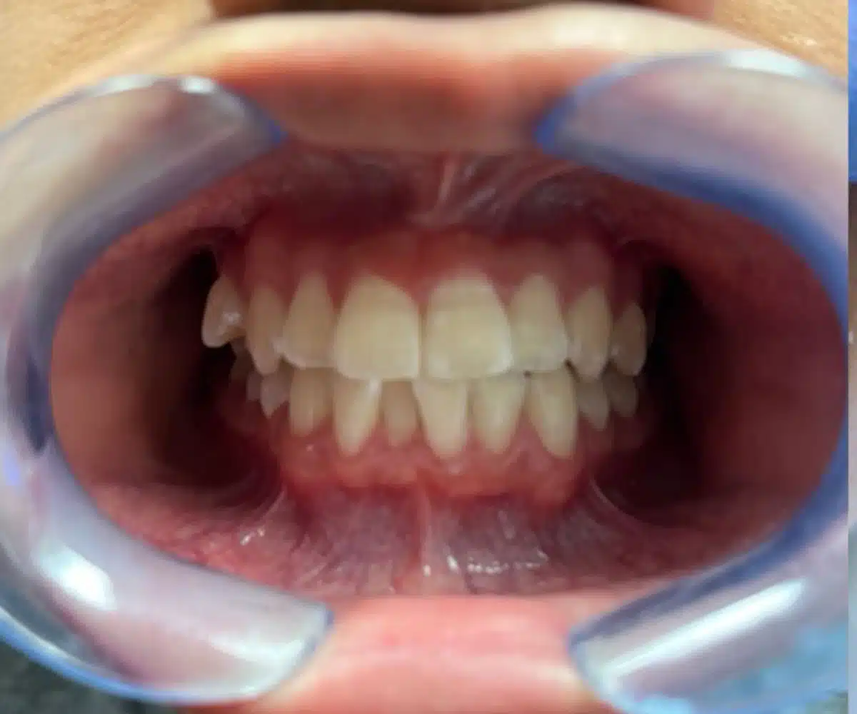 Ortho before