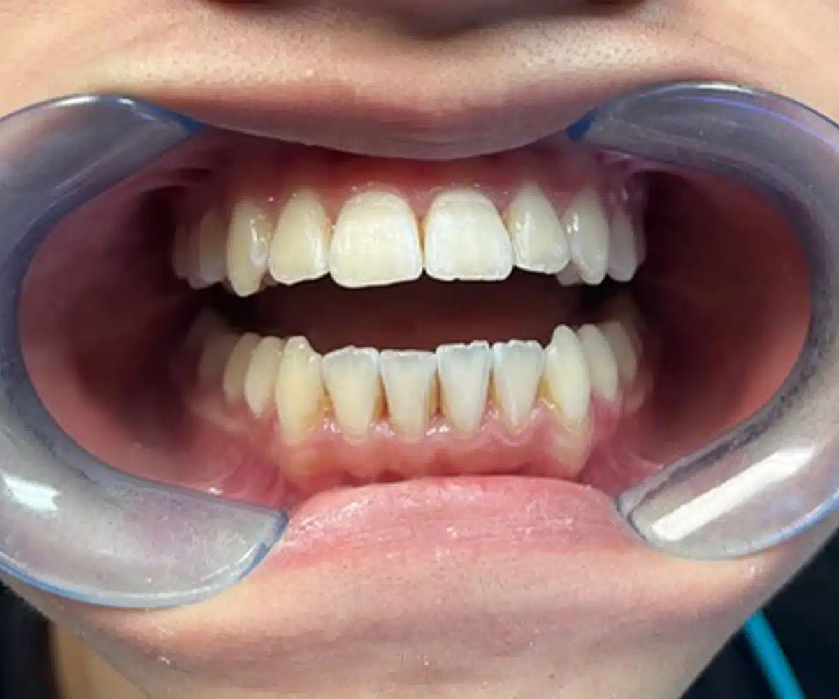 Ortho after