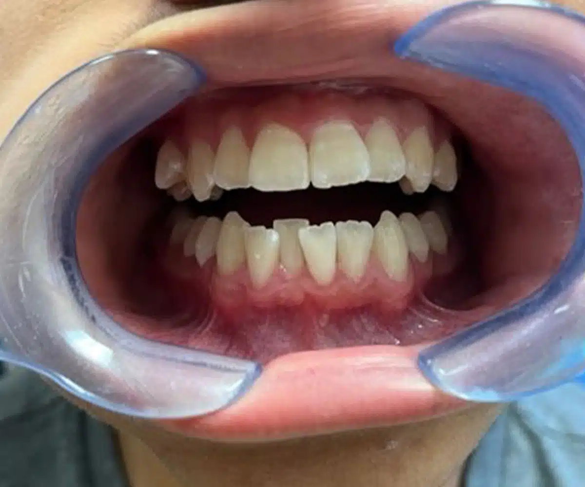 Ortho before