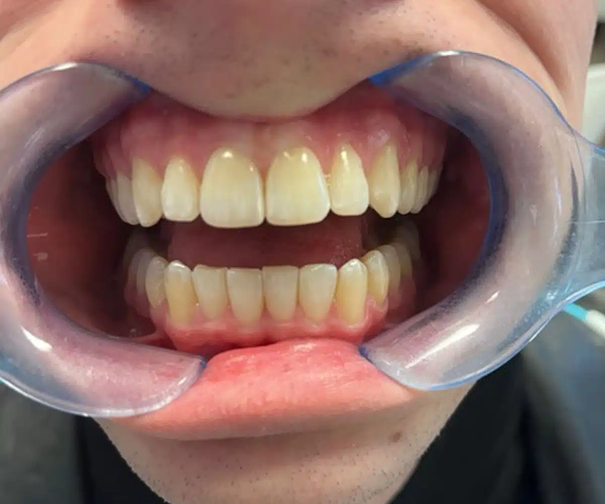 Ortho after