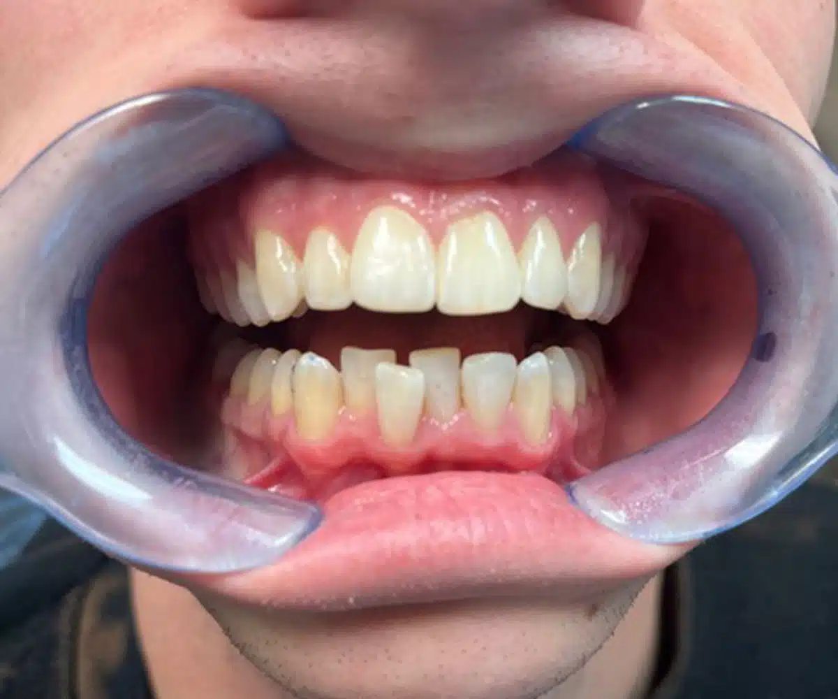 Ortho before