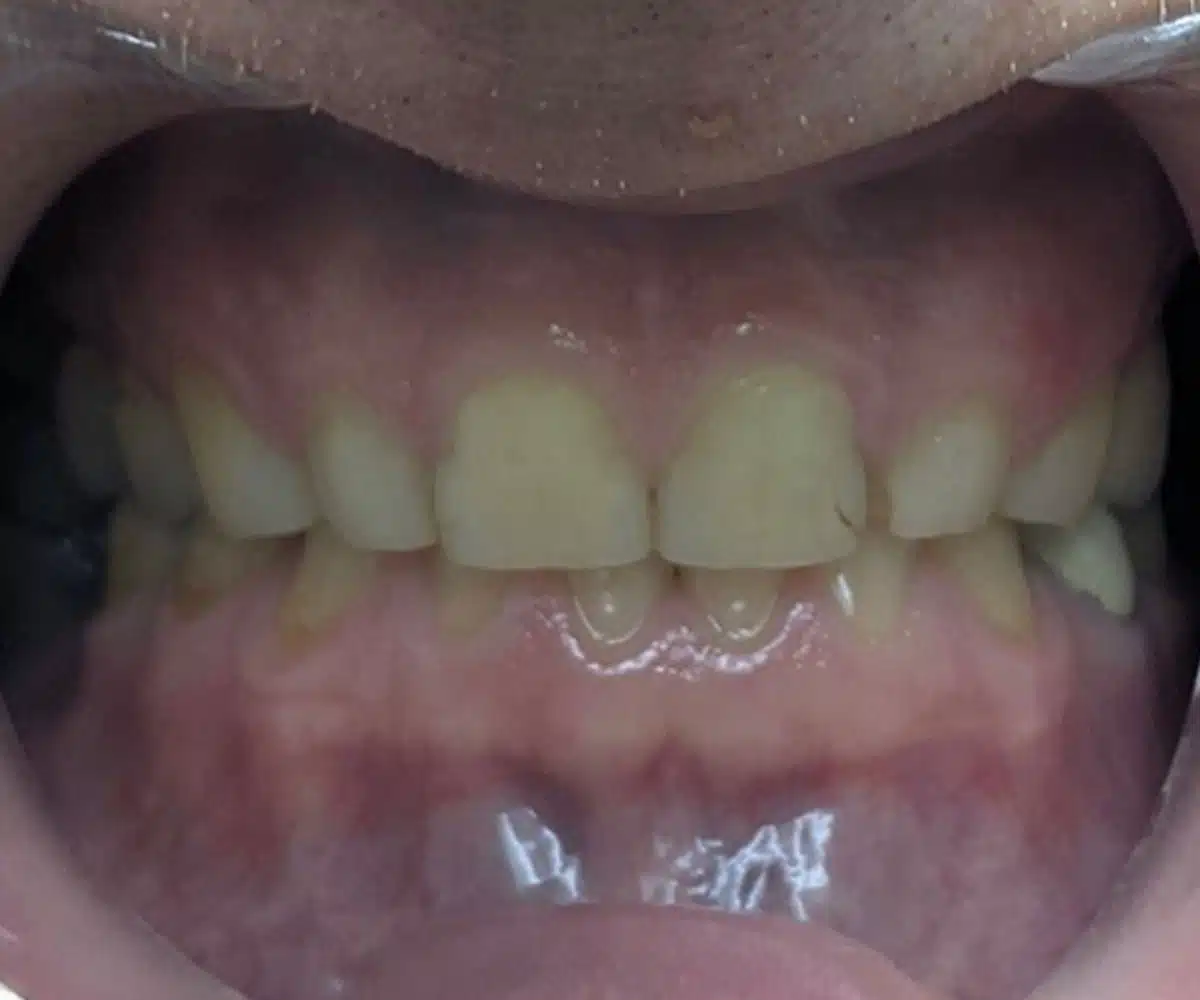 Reconstruction before