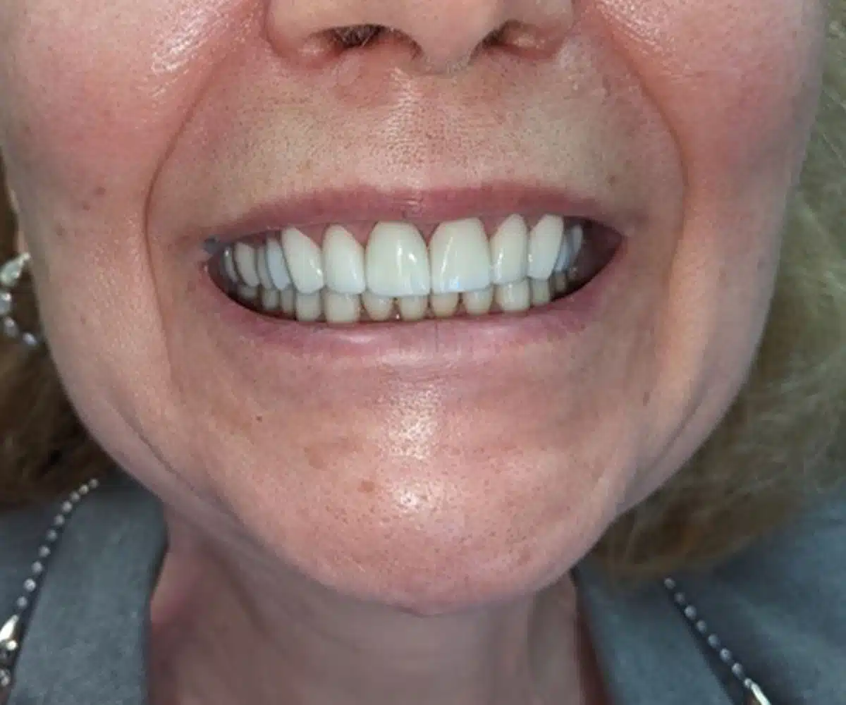 Reconstruction after