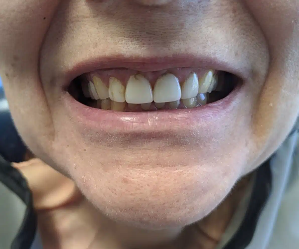 Reconstruction before
