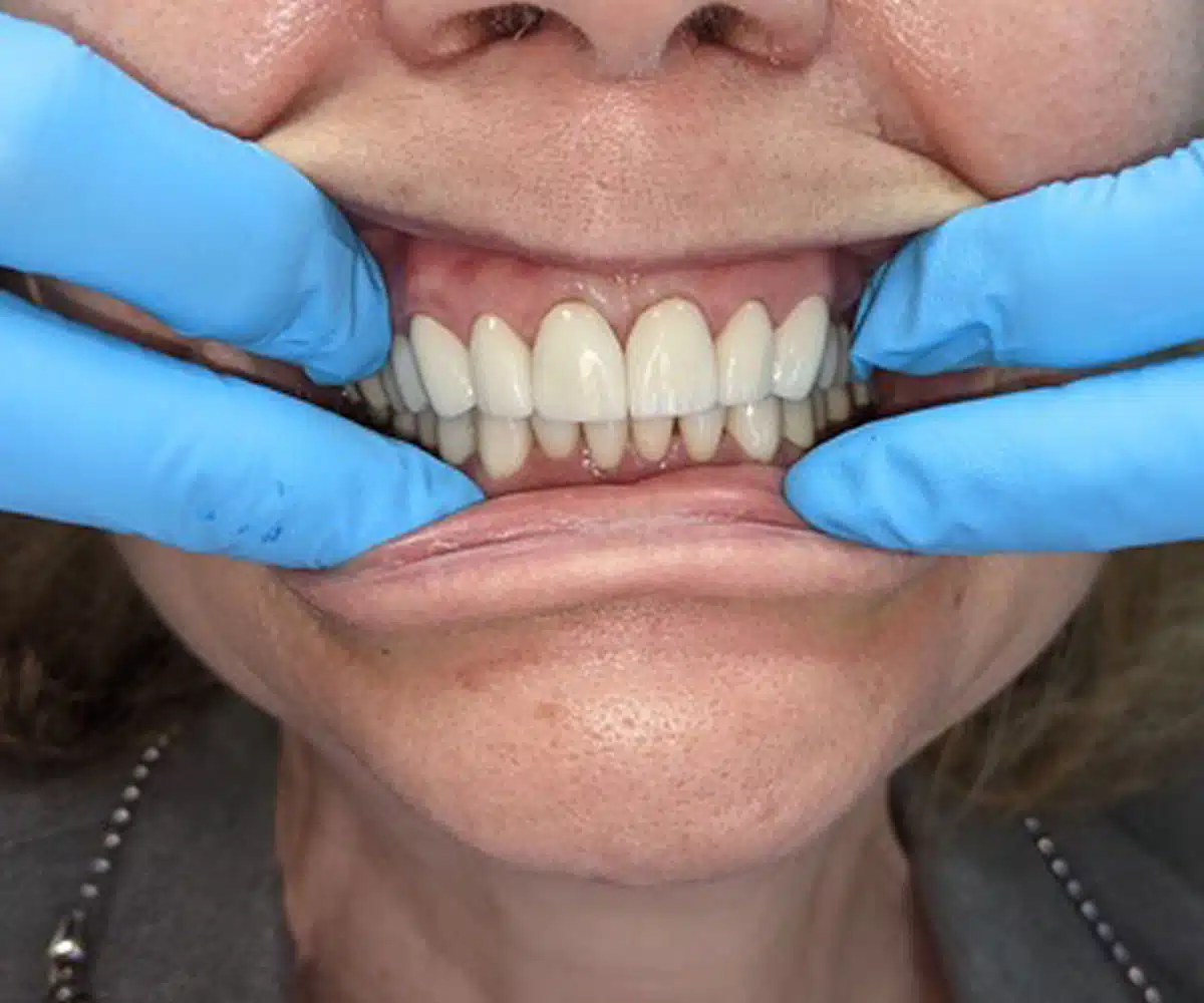 Reconstruction after