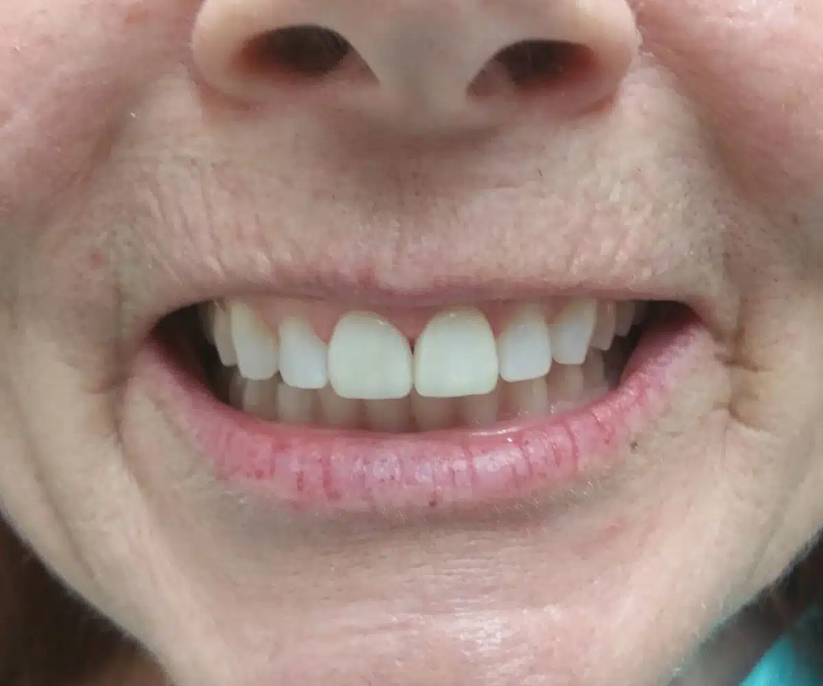 Veneers after
