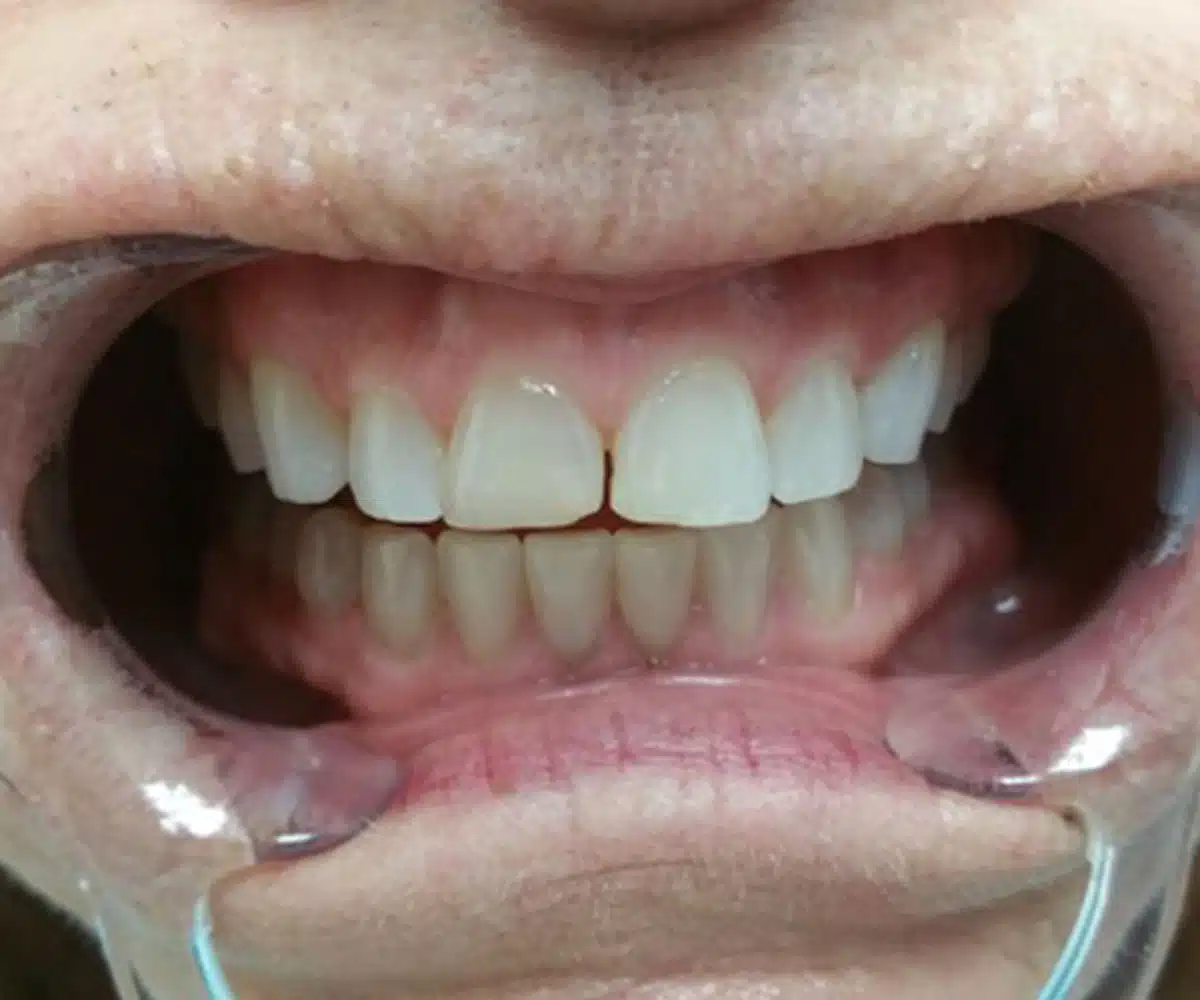 Veneers before