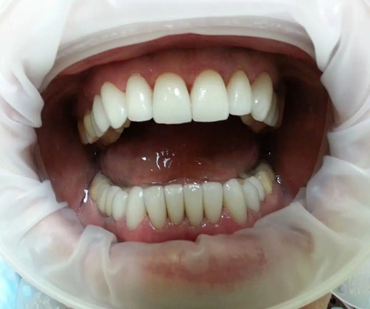 Close up Veneers after