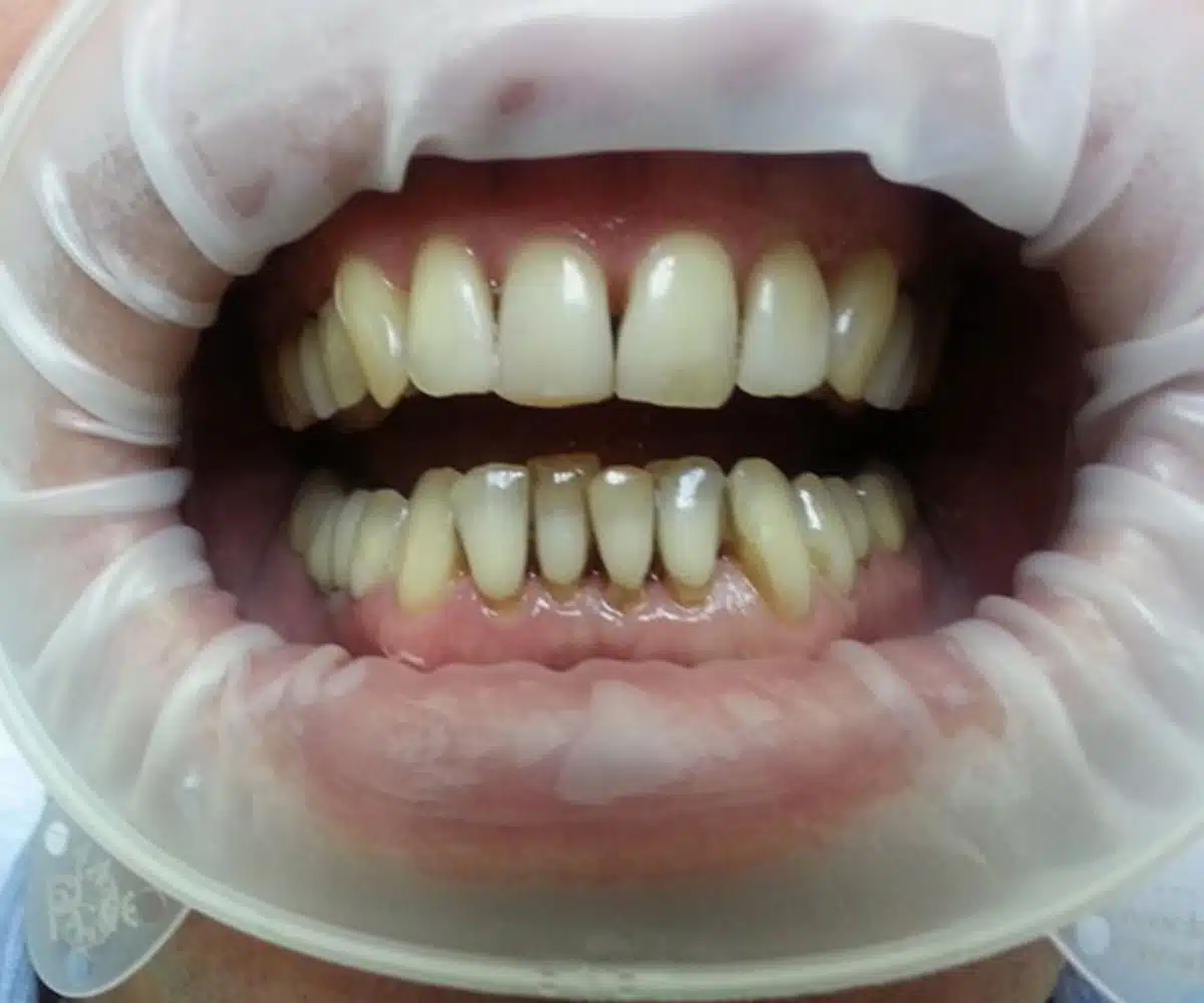 Close up Veneers before