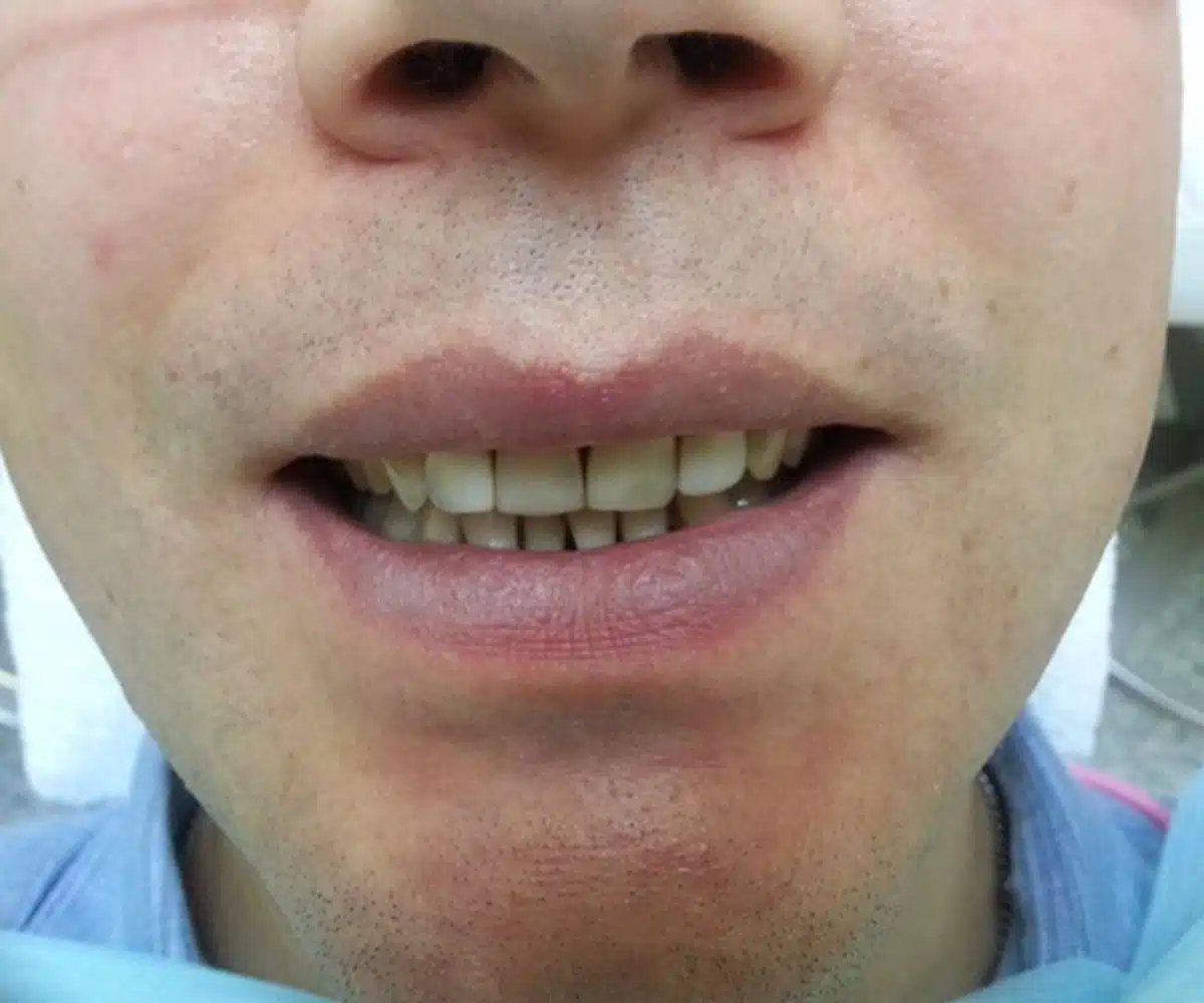 Men with black teeth