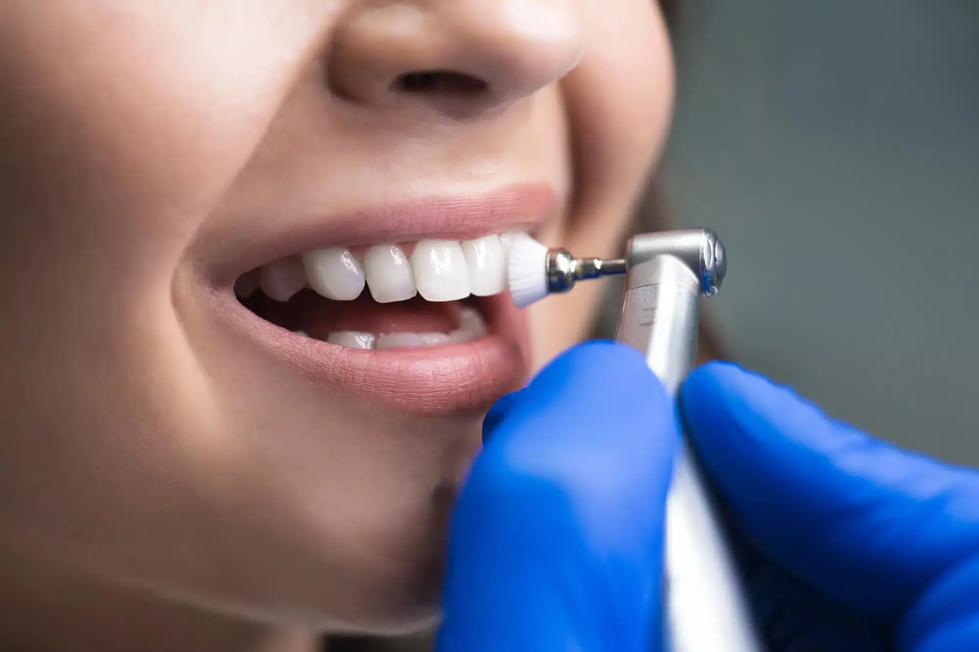 Professional Teeth Cleaning in Novi MI