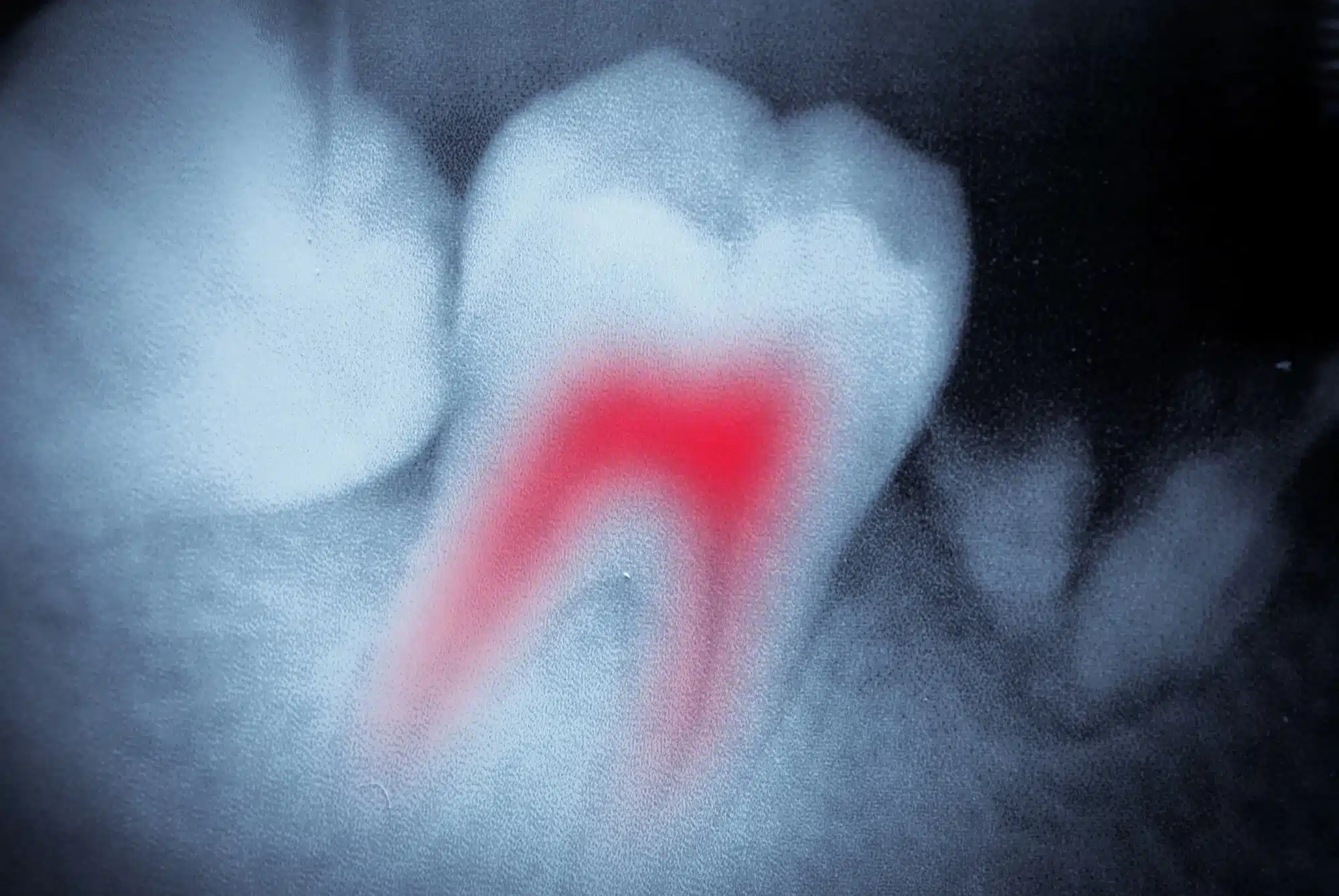 x-ray image of an impending Root Canal Extraction Near Me