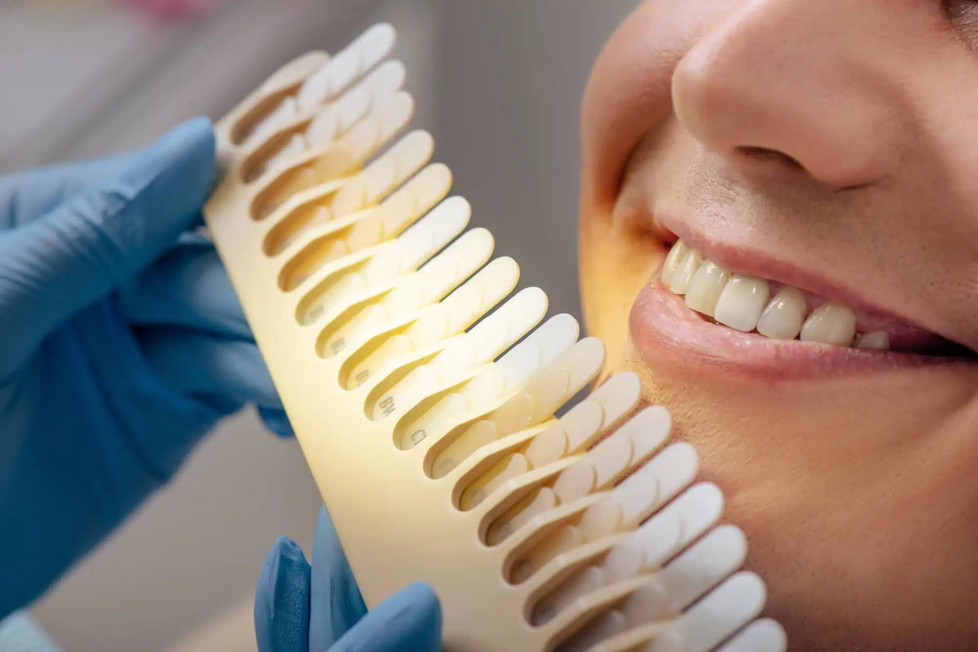 Smile-Makeover-Dentist-at-work