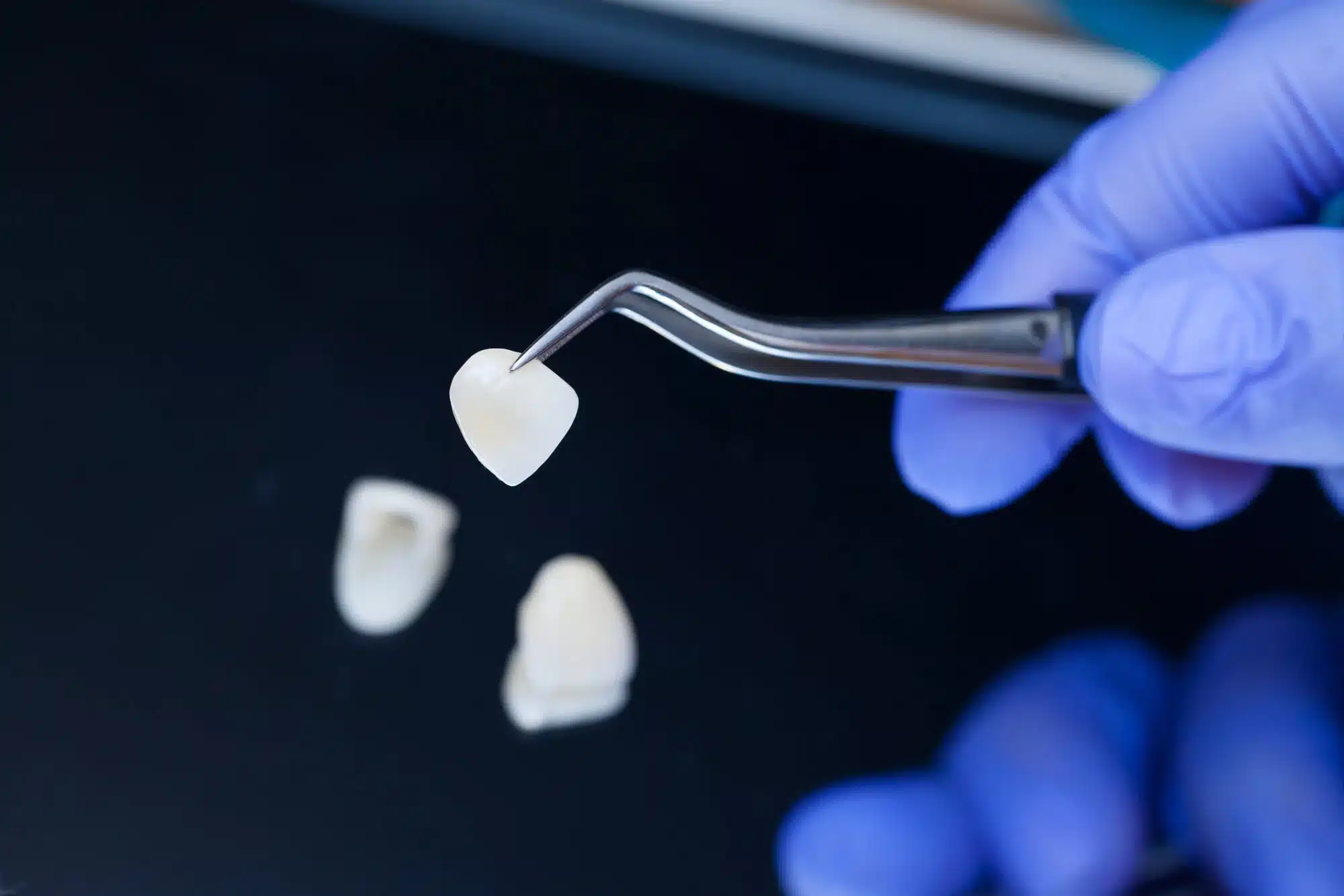 handling-Porcelain-Veneers-in-Novi-MI