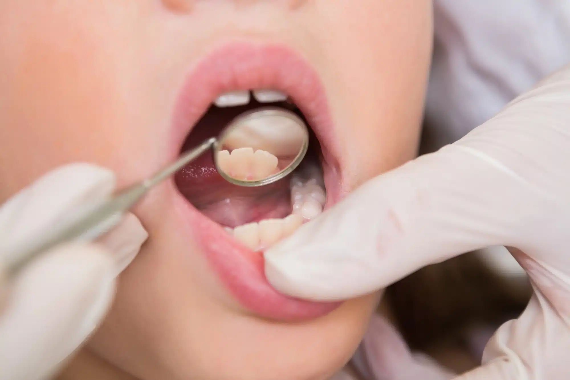 close up of mouth being inspected by an emergency dentist in Novi, MI