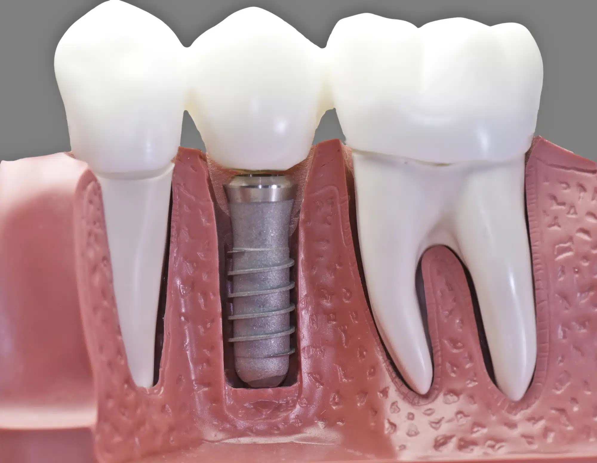 model of dental implants in Novi